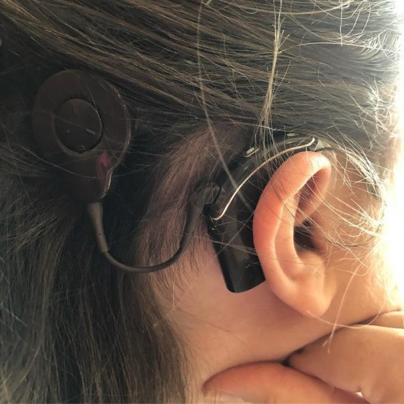 a close up of a cochlear implant on a woman’s ear