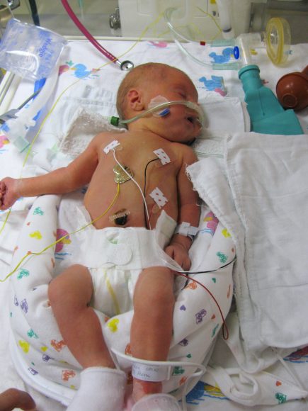 a premature baby with tubes and wires in the NICU